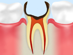C4：歯根まで浸食した虫歯